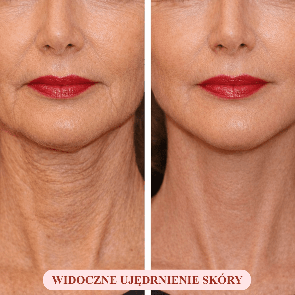 LynaFace Sculptor - Usuń podwójny podbródek i unieś linię twarzy - bezinwazyjnie i domowym sposobem!