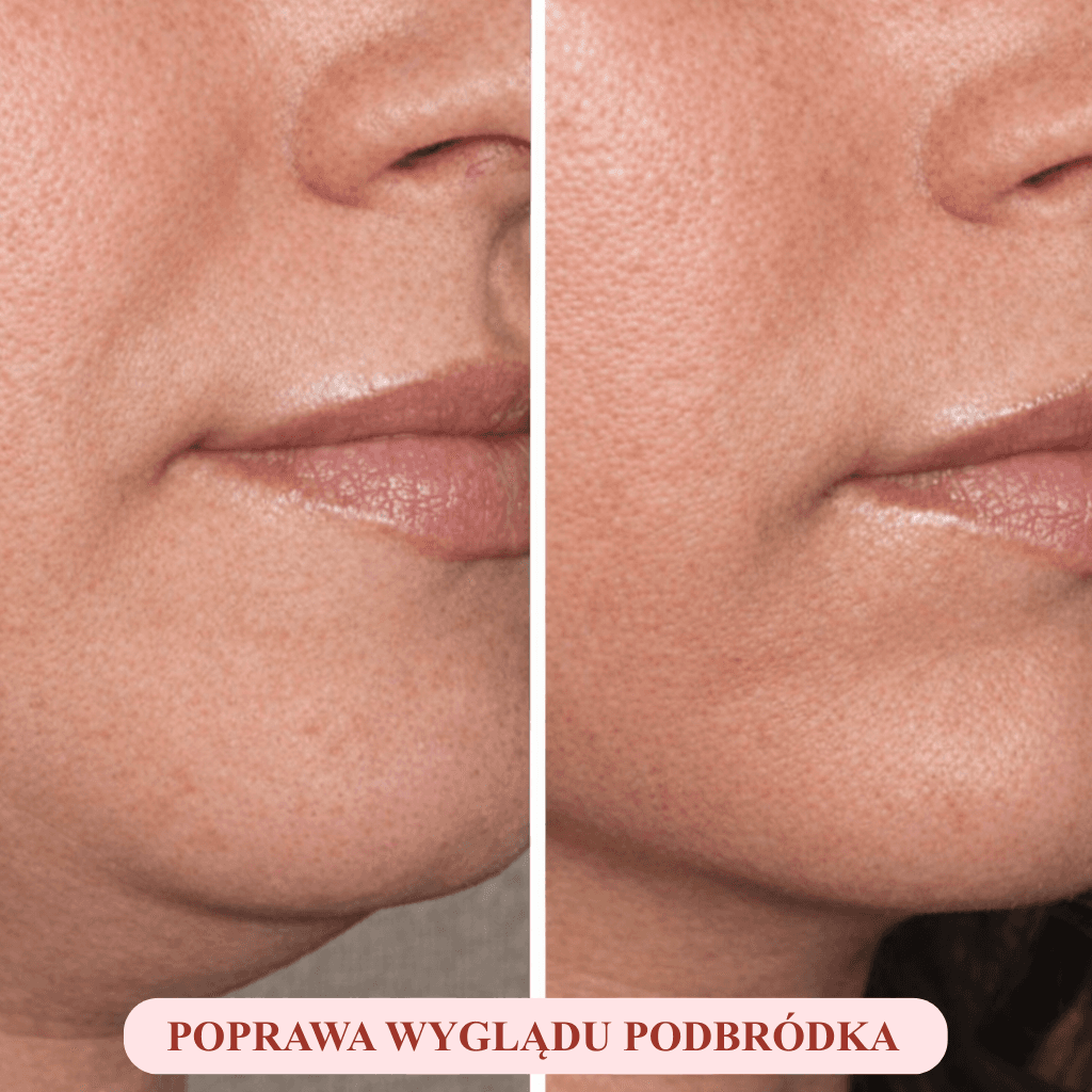 LynaFace Sculptor - Usuń podwójny podbródek i unieś linię twarzy - bezinwazyjnie i domowym sposobem!