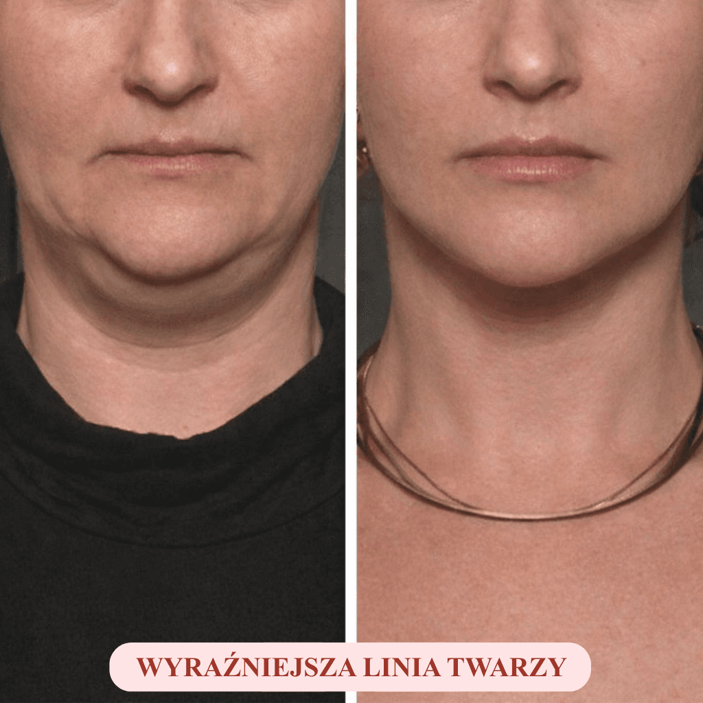 LynaFace Sculptor - Usuń podwójny podbródek i unieś linię twarzy - bezinwazyjnie i domowym sposobem!